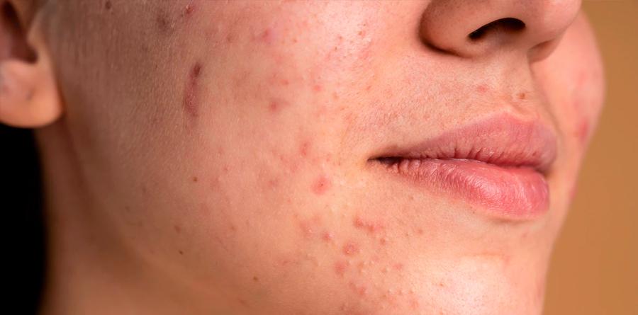 Câncer de pele: saiba como prevenir, diagnosticar e tratar